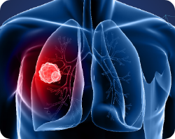 Lung Caner