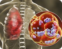 Lung Infection