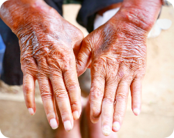 Scleroderma