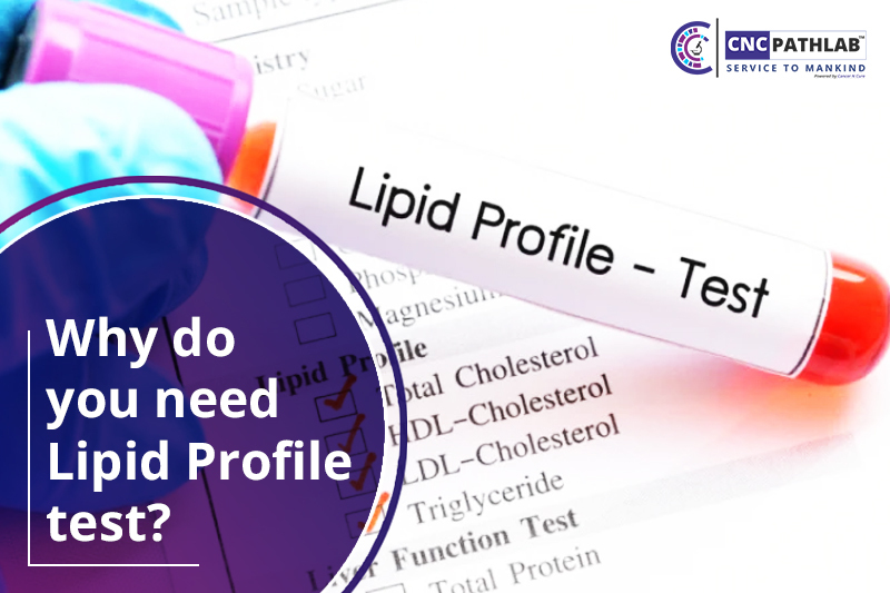 Why do you need Lipid Profile test?